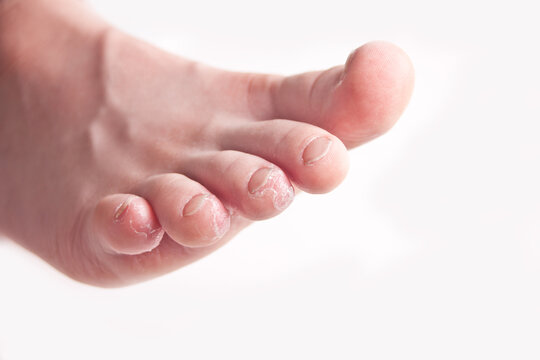 Kid feet with peel of dry skin. Closeup.