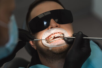 Installing or adjusting braces to correct bite. Male dentist examines the braces. Top view, close-up