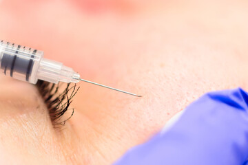 Removal of milia on the face with a syringe, cosmetic procedure on the face.