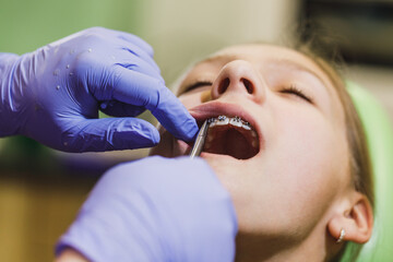 Dental Braces Checkup