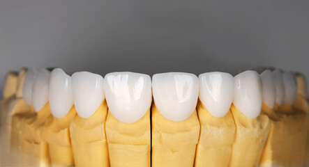 Fototapeta na wymiar Beautiful upper teeth ceramic press veneers bleach of zircon arch prothesis Implants crowns. Dental restoration treatment clinic patient. Result of oral surgery procedure whitening dentistry