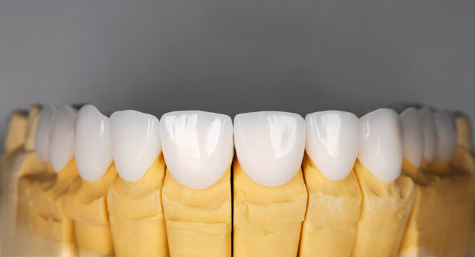 Beautiful upper teeth ceramic press veneers bleach of zircon arch prothesis Implants crowns. Dental restoration treatment clinic patient. Result of oral surgery procedure whitening dentistry
