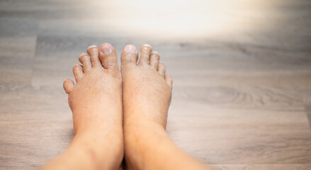 The feet of old man wrinkle skin swollen feet with the cancer and the body lack of the protein for...