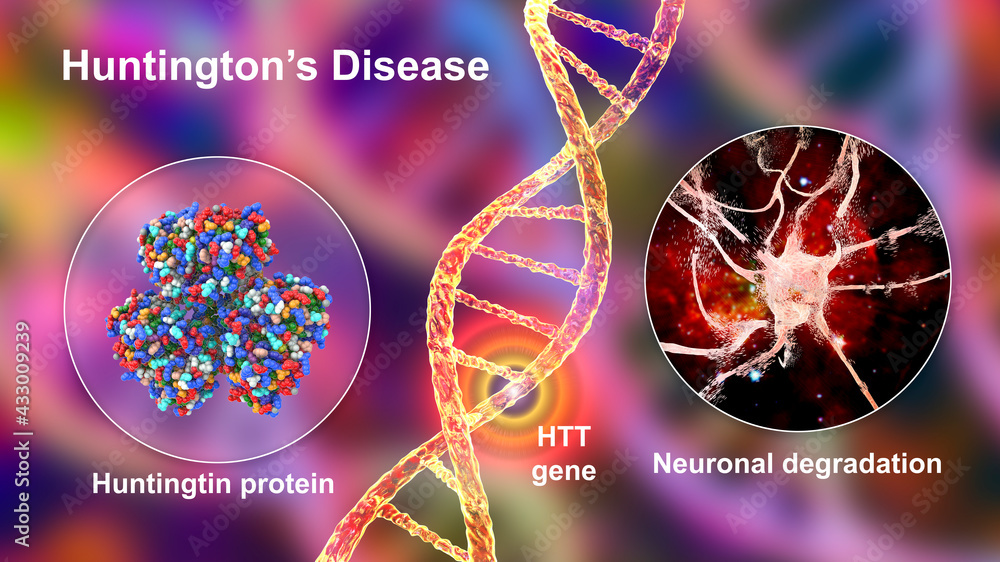 Wall mural huntington's disease, a neurodegenerative disease due to mutation in the huntingtin gene, htt, conce