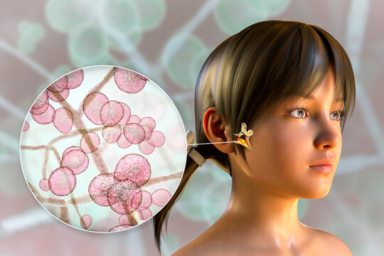 Candida fungi as a cause of otitis media