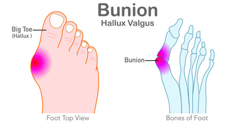 Bunion, Hallux valgus. Foot bones, joint deformed feet. Top view of the foot, angle of the big toe. Orthopedic treatment, scalloped shoes. Illustration medical draw vector