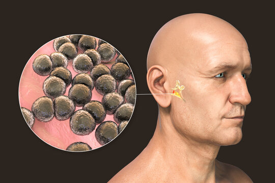 Streptococcus pneumoniae bacterium as a cause of otitis media