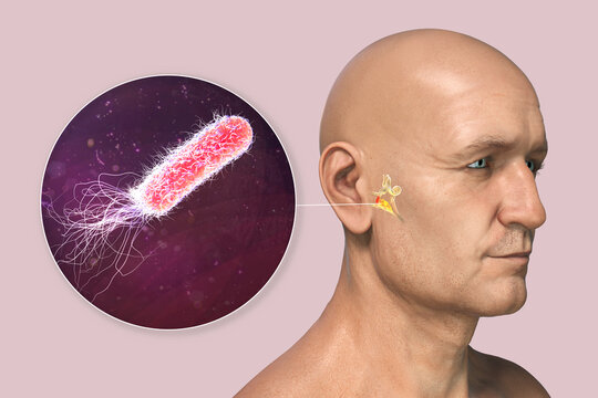 Pseudomonas aeruginosa bacterium as a cause of otitis media
