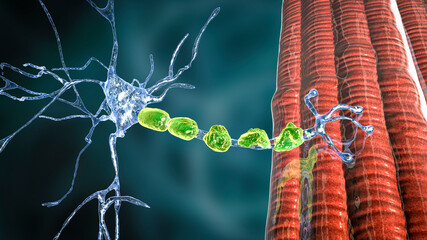 Demyelination of a neuron, the damage of the neuron myelin sheath seen in demyelinating diseases