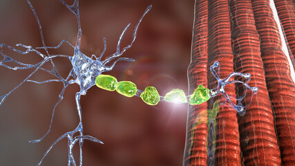 Demyelination of a neuron, the damage of the neuron myelin sheath seen in demyelinating diseases - obrazy, fototapety, plakaty