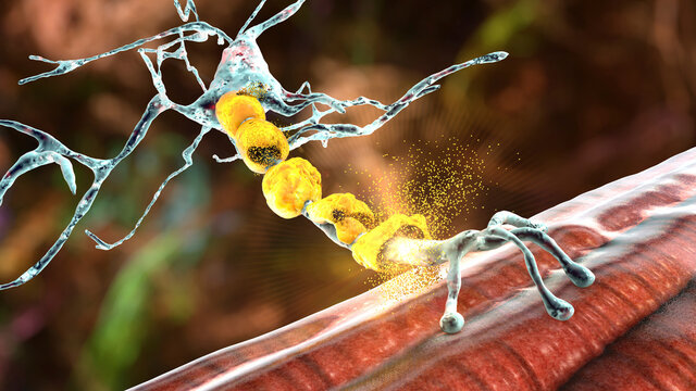 Demyelination of neuron, the damage of the neuron myelin sheath seen in demyelinating diseases