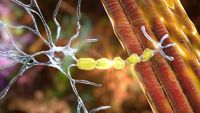 Demyelination of neuron, the damage of the neuron myelin sheath seen in demyelinating diseases