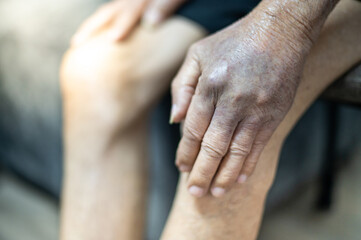 Fototapeta premium The hand of old man with the wrinkled hand and bruised from the body lack of nutrition protein.
