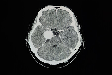 CT brain scan showing meningioma at right cavernous sinus.