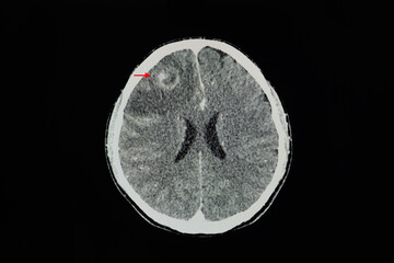A CT brain scan of a patient with large brain tumor in the frontal lobe.