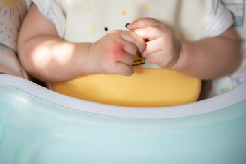 The red insect or mosquito bite on the hand of the baby