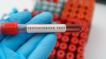 Testosterone hormone test result with blood sample in test tube on doctor hand  in medical lab - obrazy, fototapety, plakaty