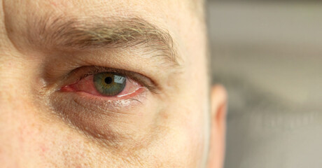 Close-up of a red and inflamed eye