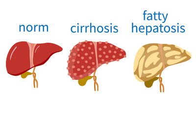liver and liver disease. cirrhosis of the liver, hepatitis, fatty hepatosis. stock vector illustration.
