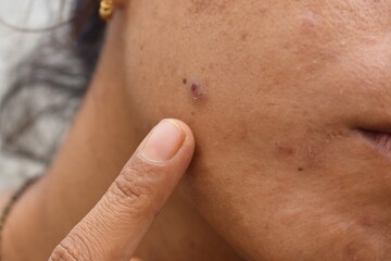 acne or pimple on face closeup