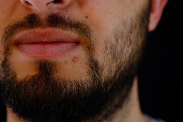 Obraz premium close up of acne on the face of a bearded young man.