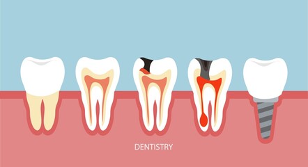 Dentistry for dental disease. Implantation. Illustration in flat style