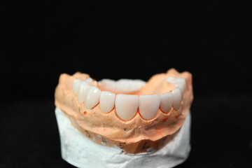Fototapeta na wymiar Dental veneers in the plaster model. Smile makeover