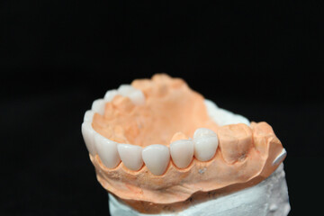 Obraz na płótnie Canvas Dental veneers in the plaster model. Smile makeover