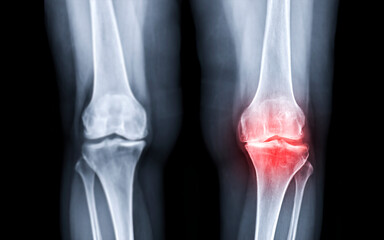 Selective focus of x-ray image of  both knee AP view for diagnostic Osteoarthritis Knee , OA Knee or fracture red zone.