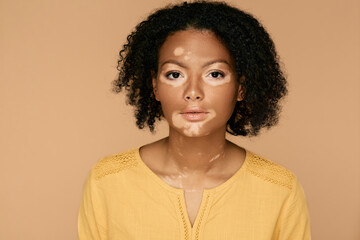 Skin abnormalities. Skin care with vitiligo and abnormal spots human body, female portrait