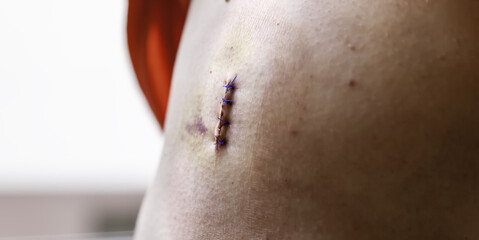 Stitches in the stomach