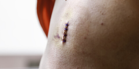 Fototapeta premium Stitches in the stomach