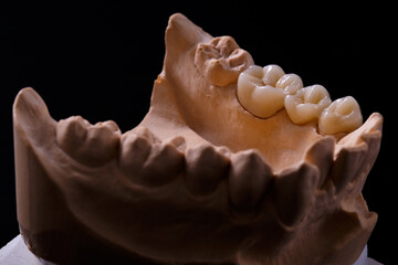 Fototapeta na wymiar Mold of teeth. Gypsum model plaster of teeth. Stomatologic plaster cast, molds of human jaws and teeth on black background. Dentistry and orthodontics concept