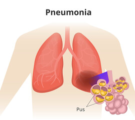 Pneumonia. Left lobar pneumonia. close up of the lung alveoli with pus