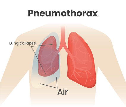 Pneumothorax illustration. Right lung collapse and air build up in a pleural cavity