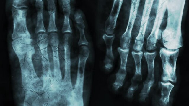 X-ray of the human foot bone or medical research