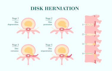 Herniated spinal disc - Degenerative, Protrusion, Extrusion, Sequestration - vector patient-friendly diagram, hand drawn. Infographic of stages hernia of intervertebral disk