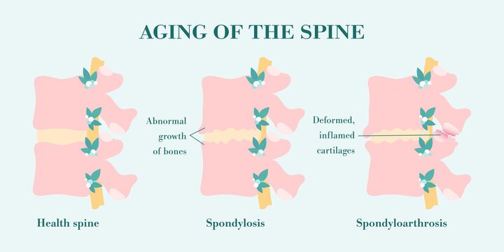 Spondylosis, bone growth of vertebral column that one of causes of the low back pain. Facet joint arthrosis, deformed and inflamed processes. Spinal disease, aging spine compared with healthy