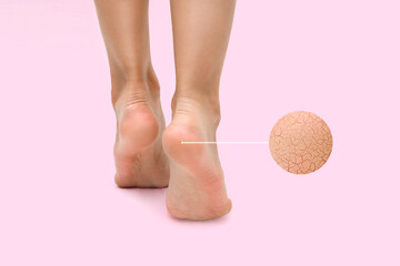heels with dry skin. cracks on the legs, Perfectly clean female legs on a pink background. Spa, pedicure, scrub and foot care