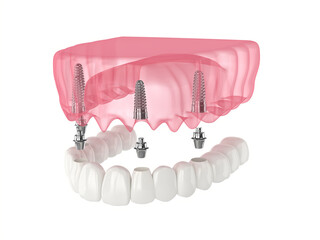 Mandibular prosthesis all on 4 system supported by implants
