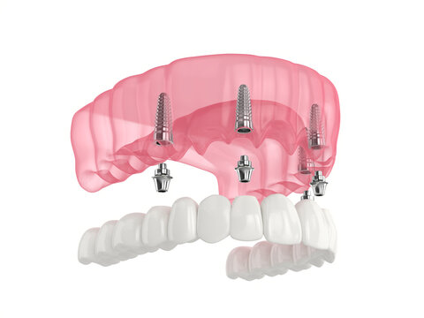 Mandibular prosthesis all on 4 system supported by implants