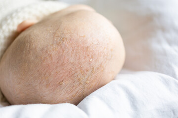 seborrheic dermatitis patches on baby's scalp hair close-up view