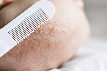 seborrheic dermatitis cradle cap flakes on a white comb removed from baby's head closeup view