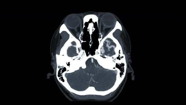 CTA Brain or computed tomography angiography of the brain Axial MIP image showing Brain AVM or arteriovenous malformation turn around on the screen.