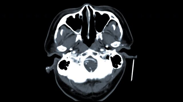  CTA brain axial MIP view after injection contrast media agent for detect cerebral artery aneurysm
