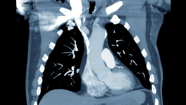 CTA Chest with contrast media Coronal MIP view for diagnostic Pulmonary embolism (PE) and lung cancer .