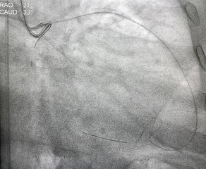 Retrograde guide wire to right coronary artery (RCA) in coronary chronic total occlusion (CTO)...