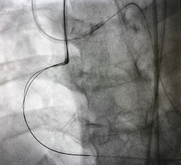 Retrograde guide wire to right coronary artery (RCA) in coronary chronic total occlusion (CTO) lesion during percutaneous coronary intervention (PCI).