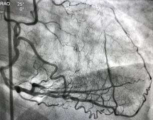coronary angiogram showed right coronary artery (RCA) given collateral to left anterior descending artery (LAD) that had chronic total occlusion (CTO). - obrazy, fototapety, plakaty