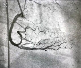 coronary angiogram showed right coronary artery (RCA) given collateral to left anterior descending artery (LAD) that had chronic total occlusion (CTO). - obrazy, fototapety, plakaty